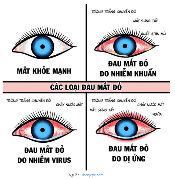 Tuyên truyền bệnh đau mắt đỏ